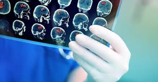 Безоплатні медичні послуги у випадку інсульту під час війни